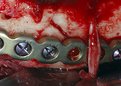 Picture Title - fracture repair