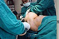 Picture Title - Liposuction