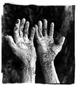 Picture Title - Leprosy