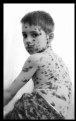 Picture Title - ...chiken pox...