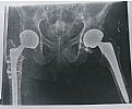 Picture Title - HIP SURGERY X-RAY